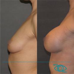  Асимметрия молочных желез