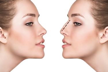  Как убрать горбинку на носу