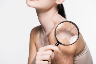  Пигментные пятна