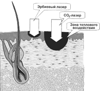 Лазерная хирургия