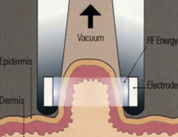 Лифтинг лазером