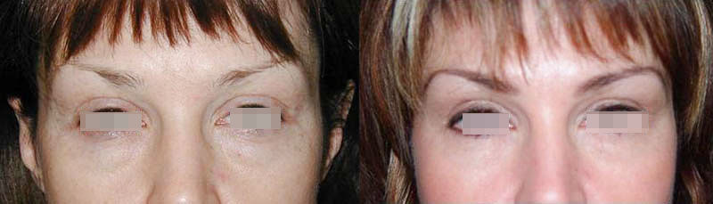 Пластика век (блефаропластика)