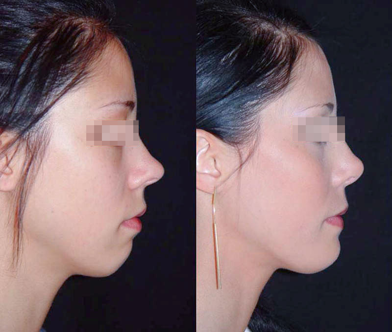 Ринопластика в сочетании с имплантатом подбородка