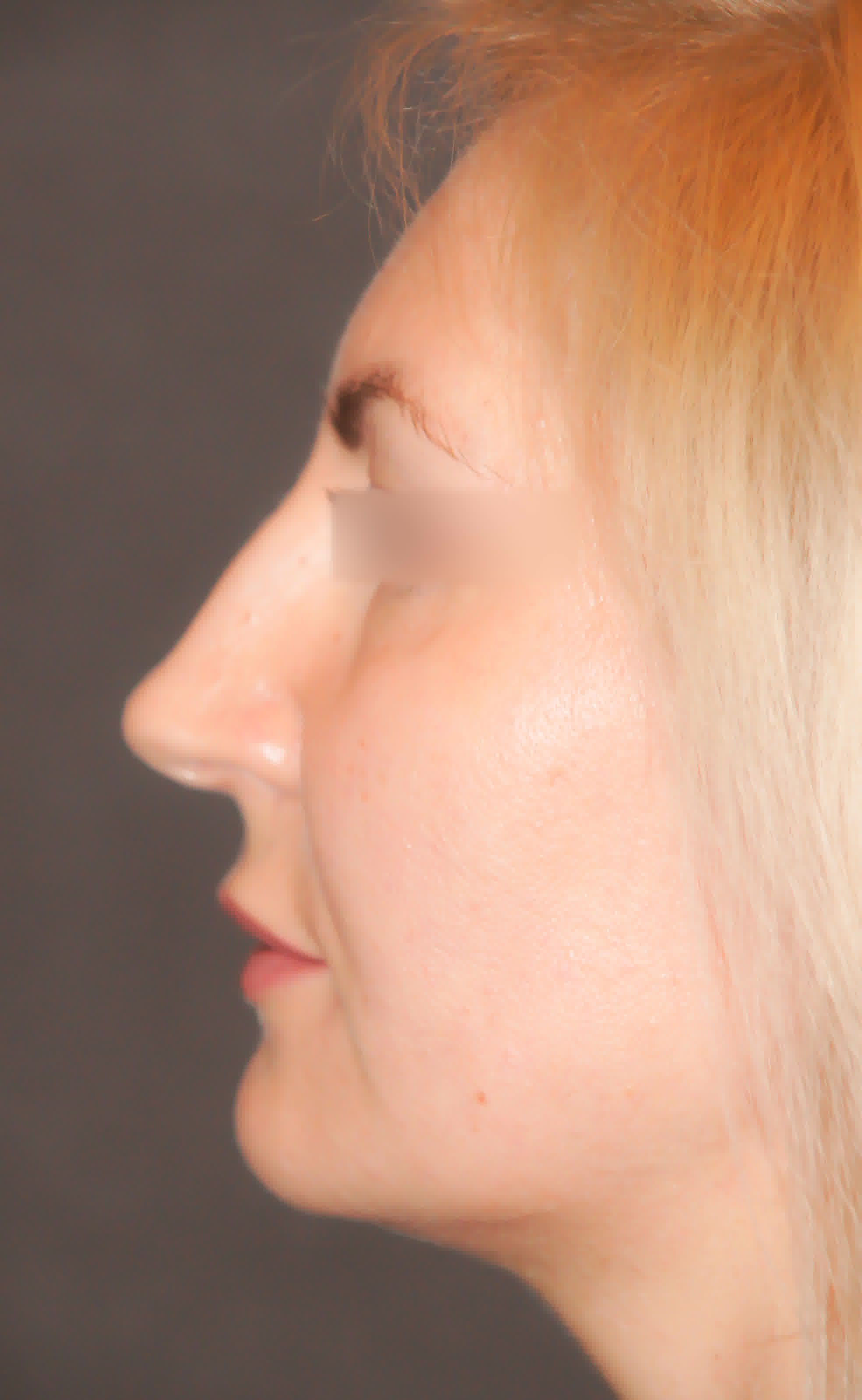 Ринопластика 2