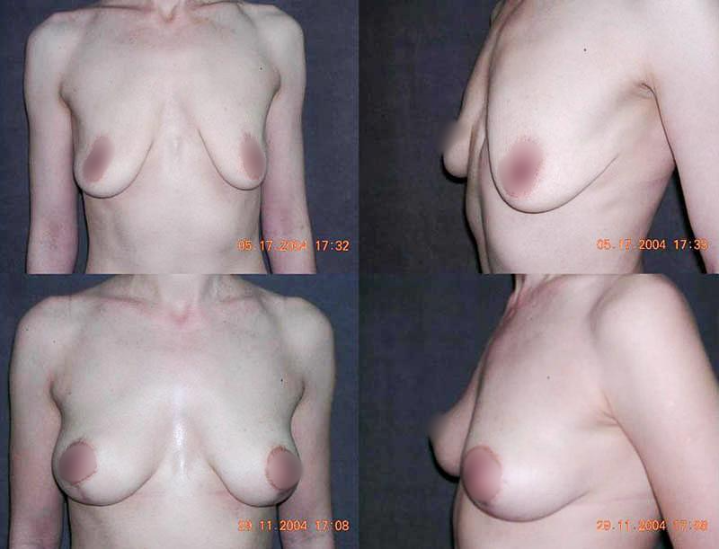 Мастопексия с вертикальным рубцом