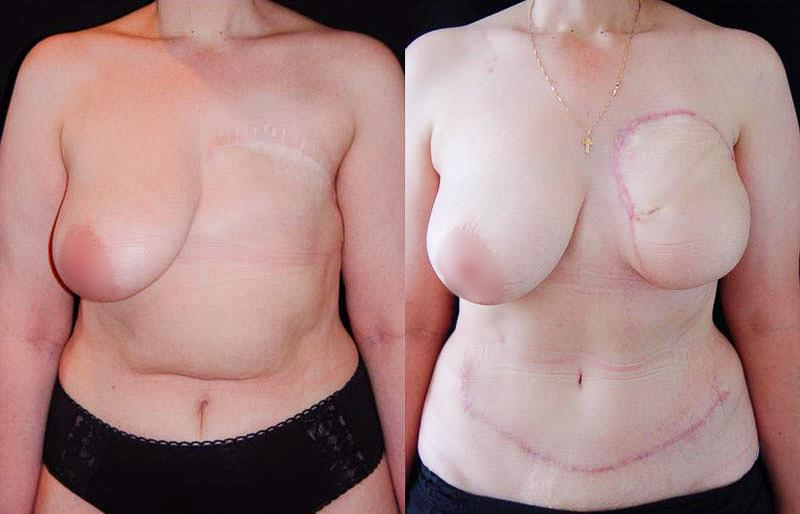 Реконструкции груди и молочных желез