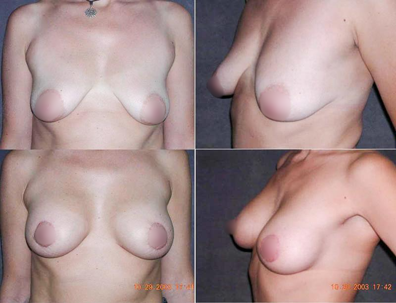 Эндопротезирование и мастопексия