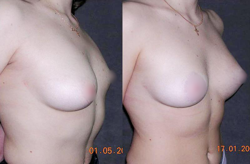 Коррекция асимметрии молочных желез, деформации груди