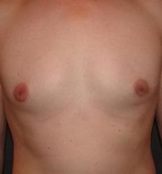 Коррекция гинекомастии