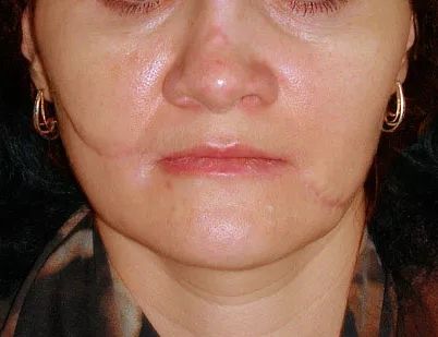 Коррекция рубцов