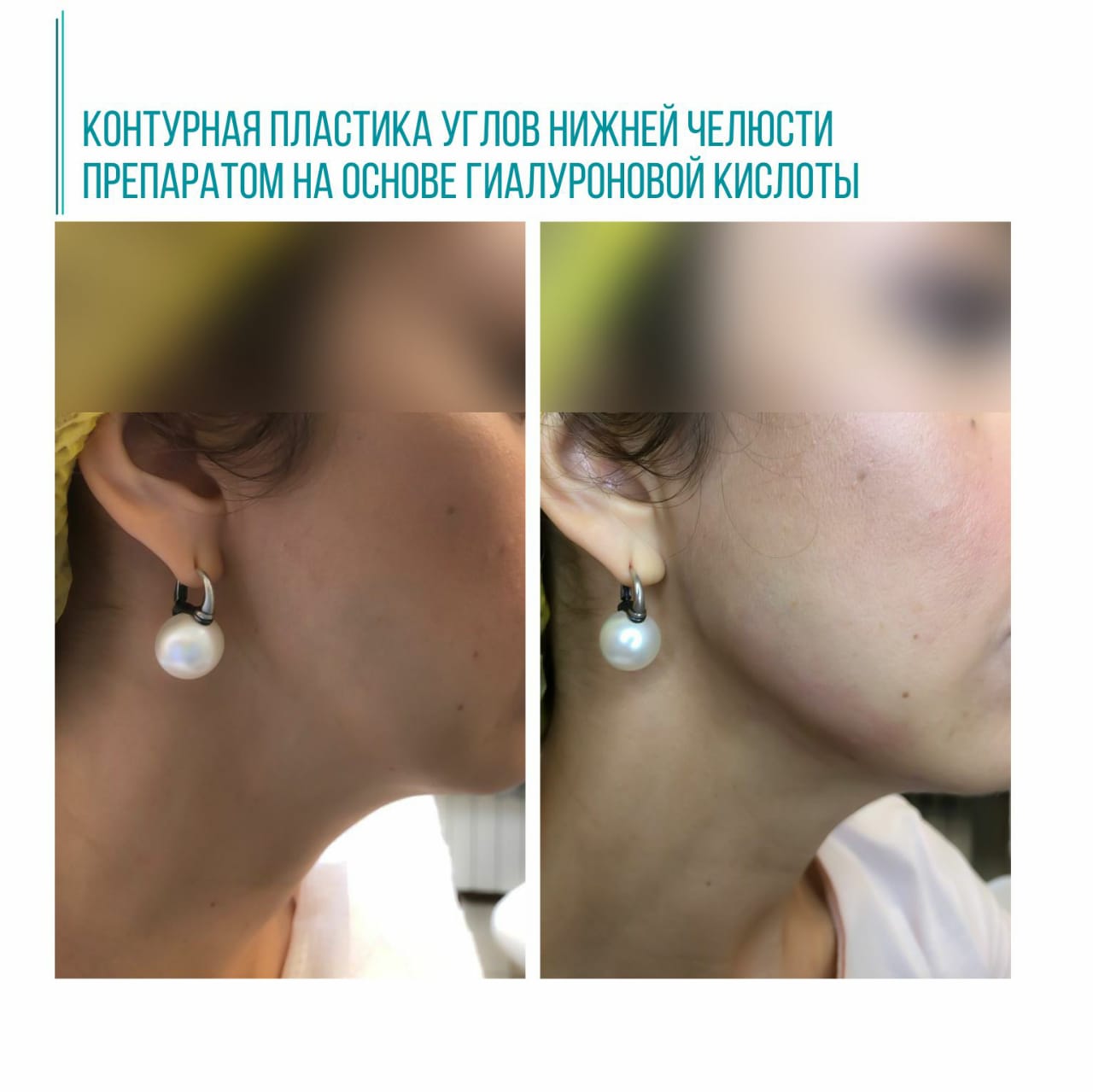 Контурная пластика углов нижней челюсти препаратом на основе гиалуроновой кислоты
