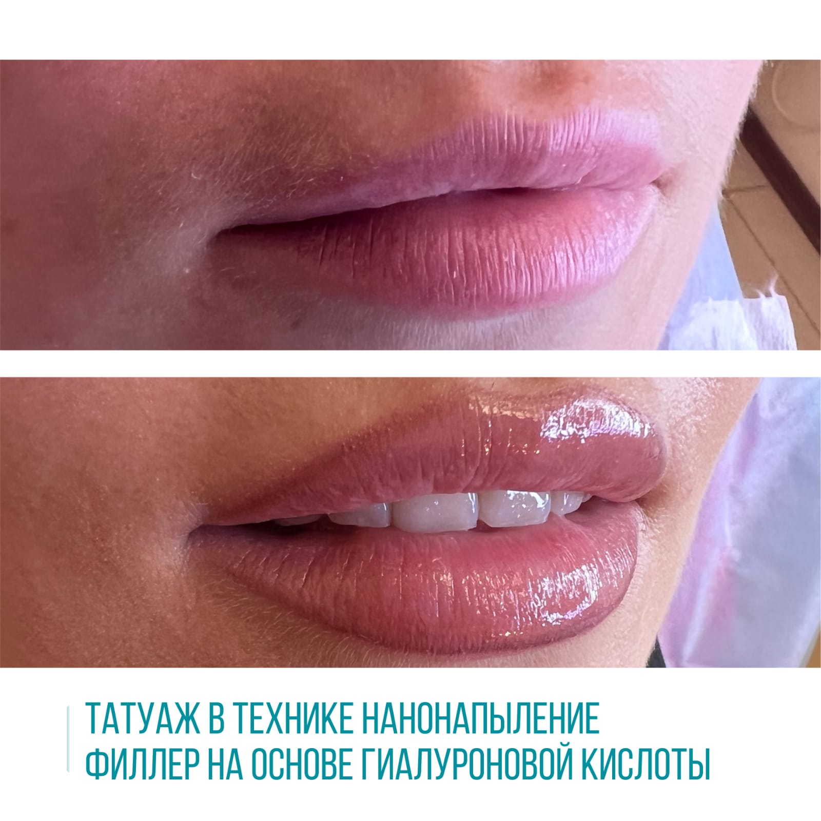 Татуаж в технике нанонапыление и увеличение губ филлером на основе гиалуроновой кислоты