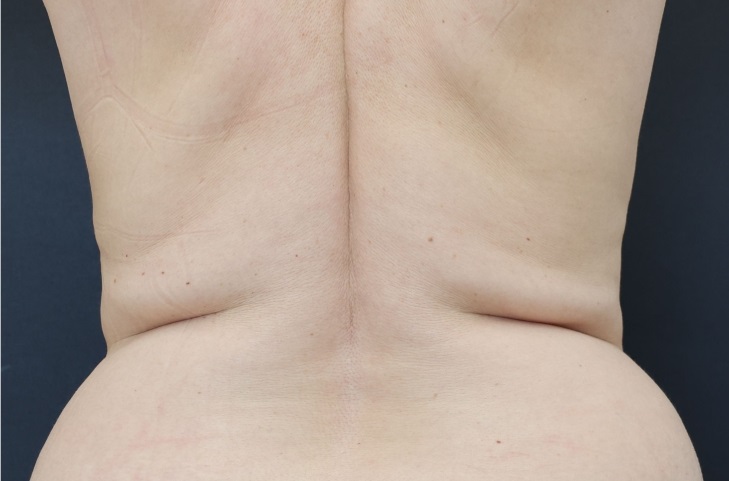 Липосакция талии