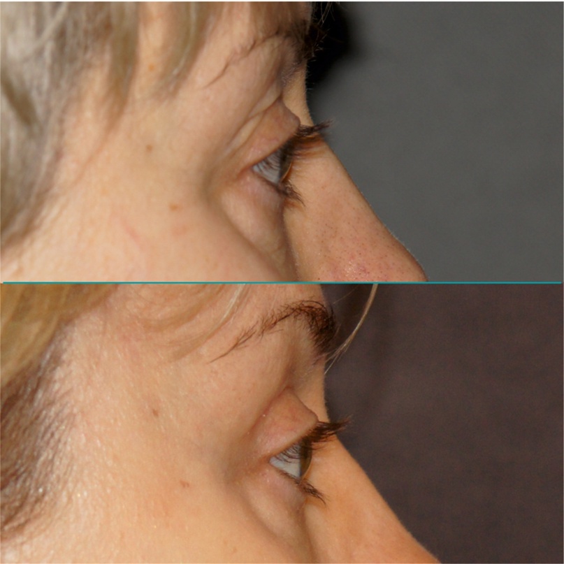 результат височного лифтинга фото 1