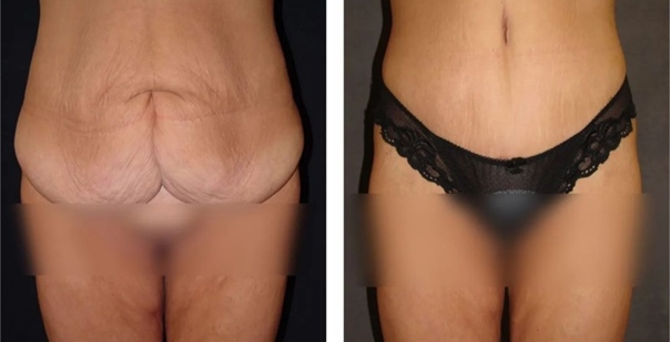 Подтяжка фото2