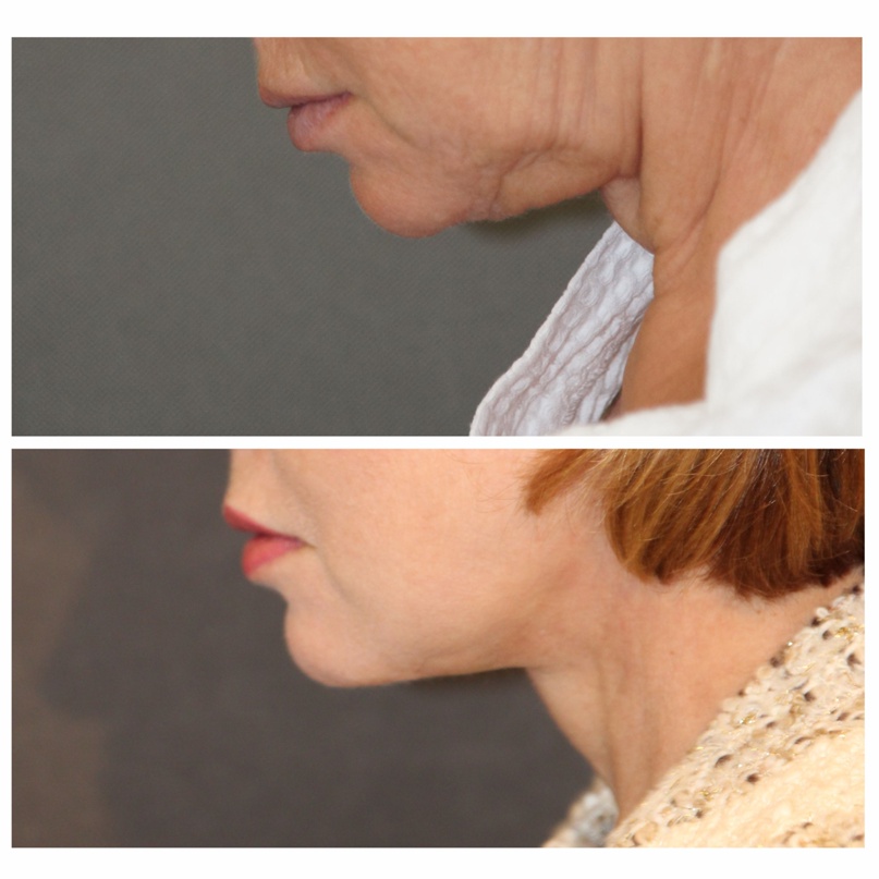 подтяжки шеи фото 2