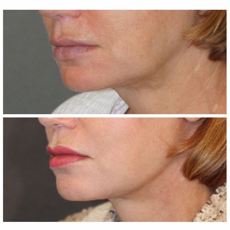 подтяжки шеи фото 3