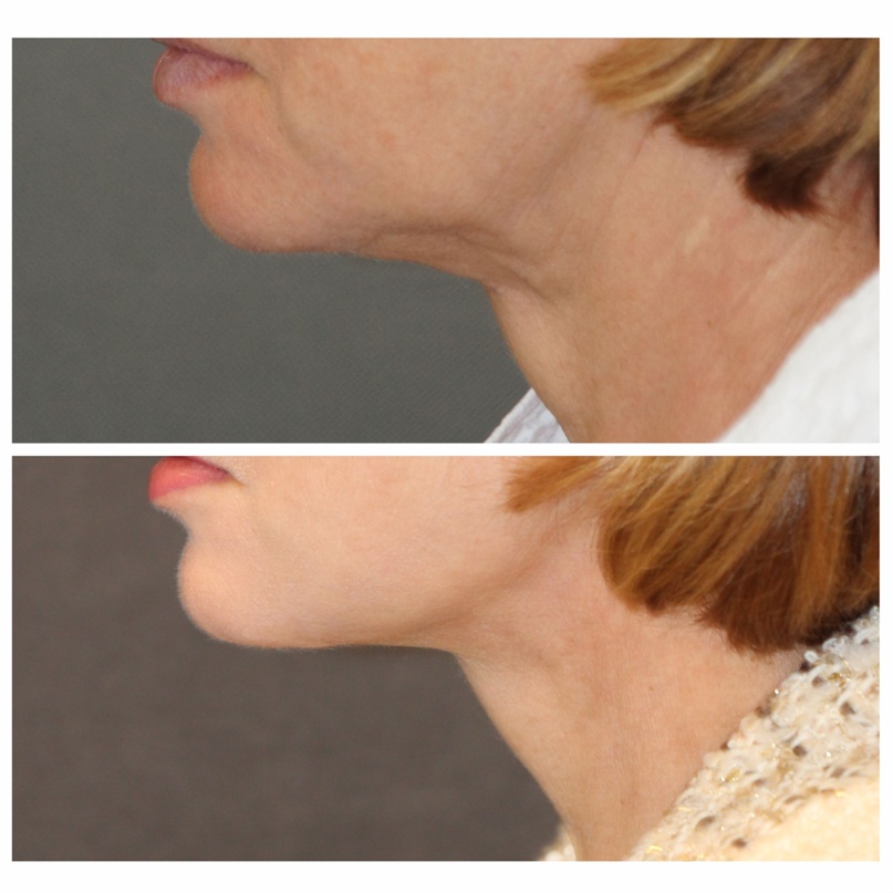 подтяжки шеи фото 4