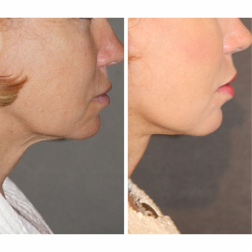 подтяжки шеи фото 5