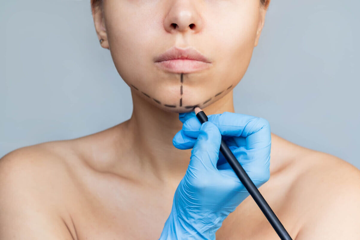 Изображение лица с предоперационной разметкой в области подбородка