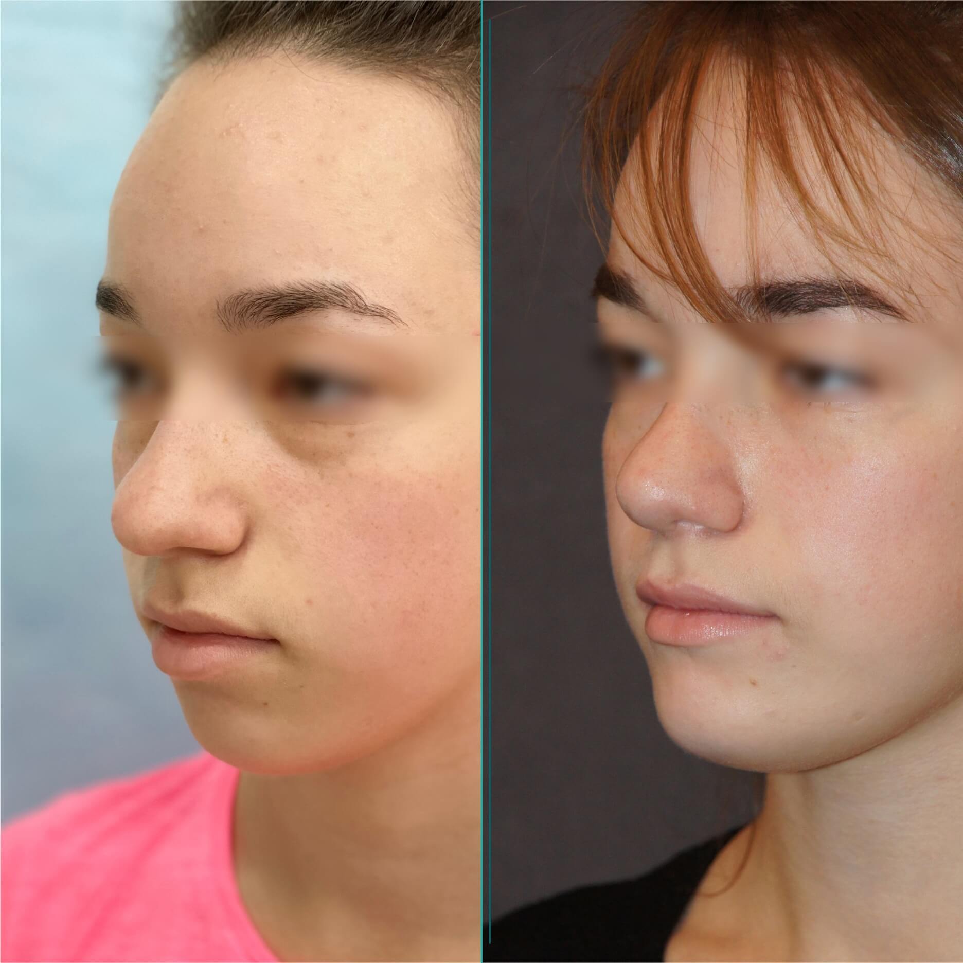 Операция по имплантации подбородка (пример 1)