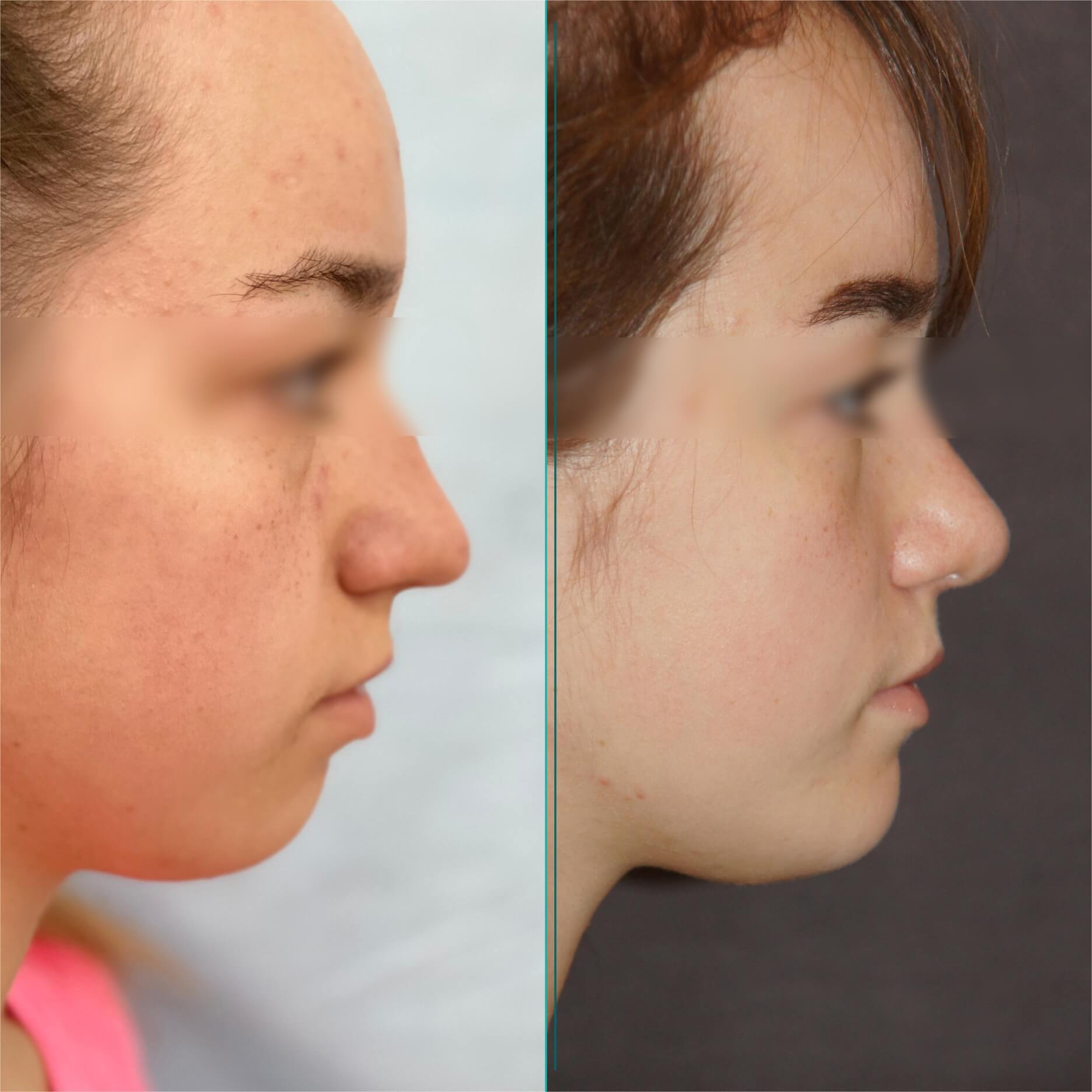 Операция по имплантации подбородка (пример 2)