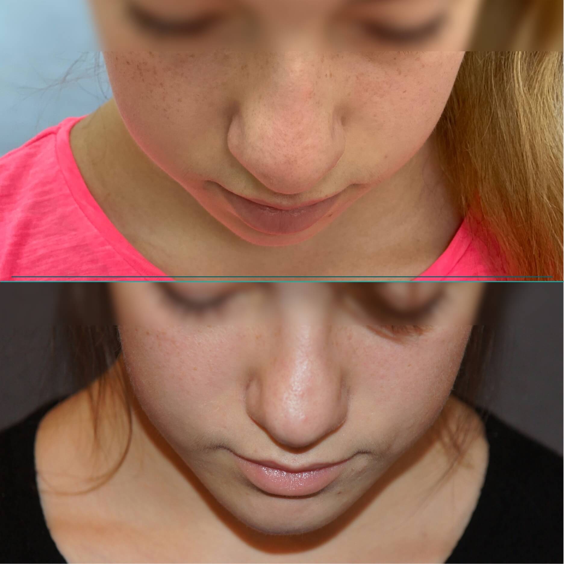 Операция по имплантации подбородка (пример 3)